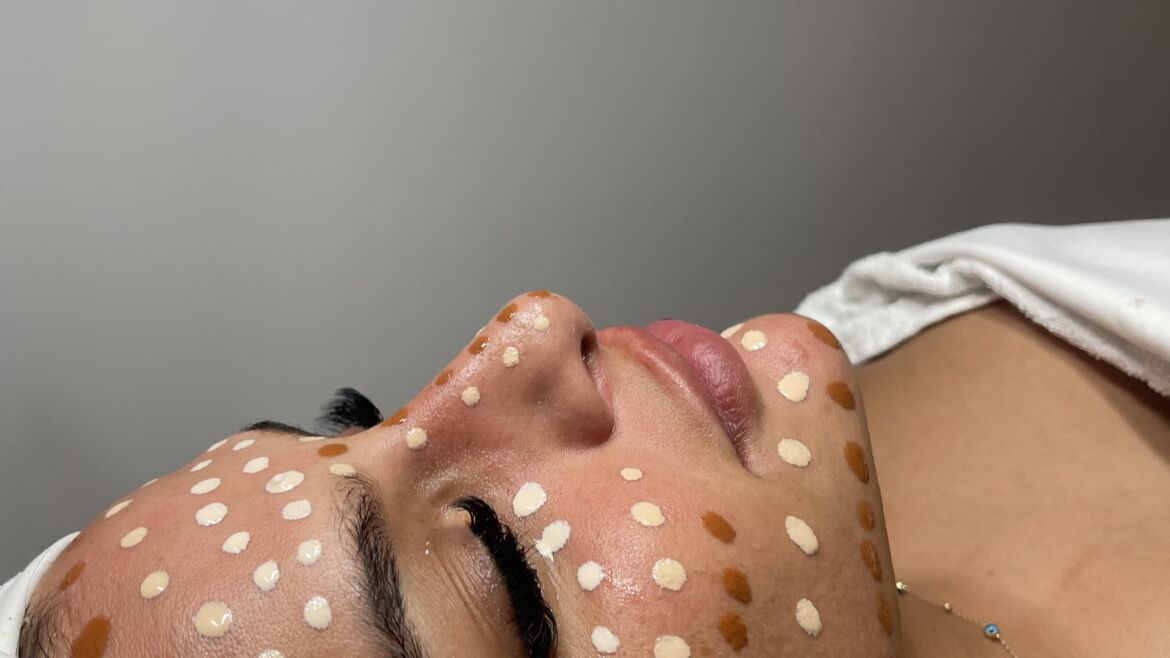 Microneedling